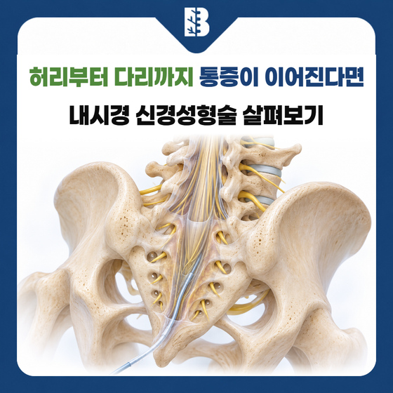 은평구신경외과 엉치뼈 쪽 경막외 카테터의 접근 경로와 신경 구조 그림