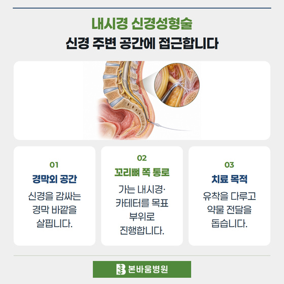 은평구신경외과 경막외 카테터 접근 구조 — 내시경 신경성형술 · 신경 주변 공간에 접근합니다