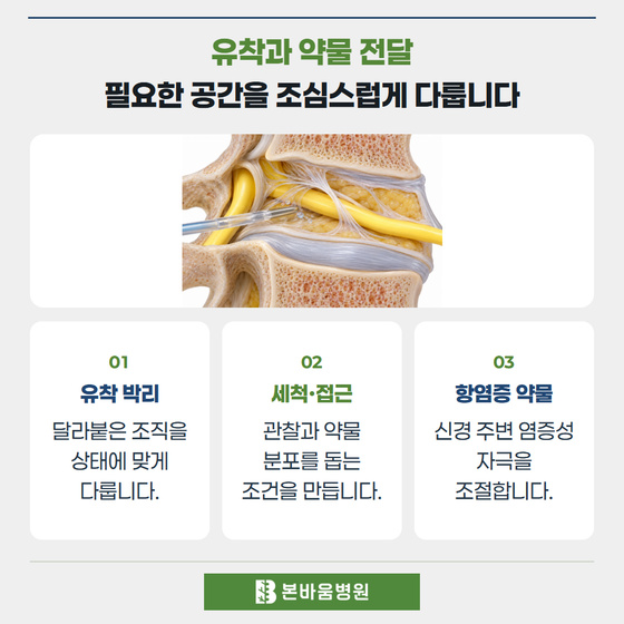은평구신경외과 신경 주변 유착과 카테터 그림 — 유착과 약물 전달 · 필요한 공간을 조심스럽게 다룹니다