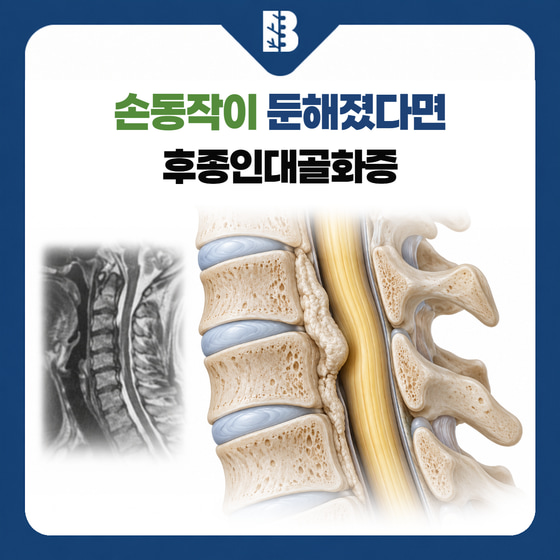 후종인대골화증 썸네일: 목뼈 뒤쪽 인대와 척수의 위치를 보여주는 설명 그림