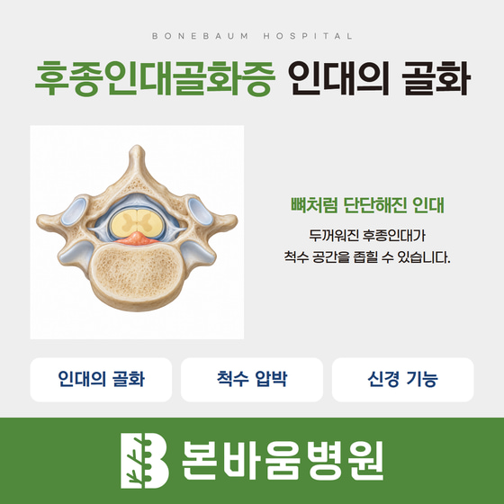 척추뼈 단면에서 골화된 후종인대가 척수 앞쪽 공간으로 돌출되는 모습을 나타낸 설명 그림