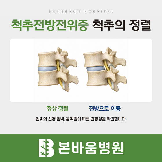 정상 정렬과 위쪽 척추뼈가 앞으로 이동한 상태를 비교한 척추전방전위증 설명 그림
