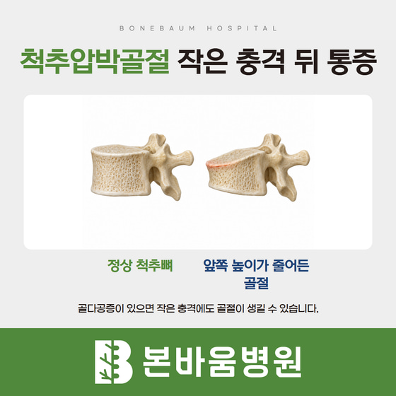 정상 척추뼈와 앞쪽 높이가 줄어든 쐐기 모양 압박골절을 비교한 설명 그림