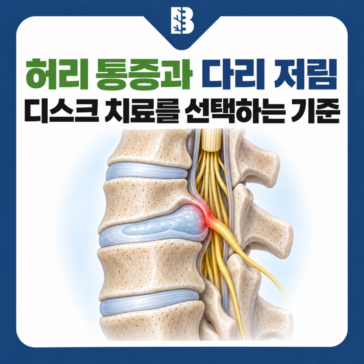 은평구신경외과 허리디스크 다리 저림이 이어진다면