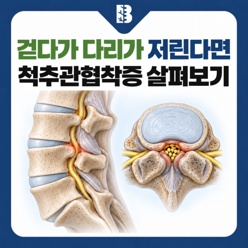 은평구신경외과 척추관협착증, 걷다가 다리가 저려 쉬게 된다면