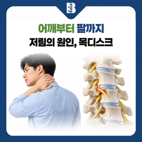 은평구신경외과 목디스크, 어깨를 주물러도 팔 저림이 남는다면